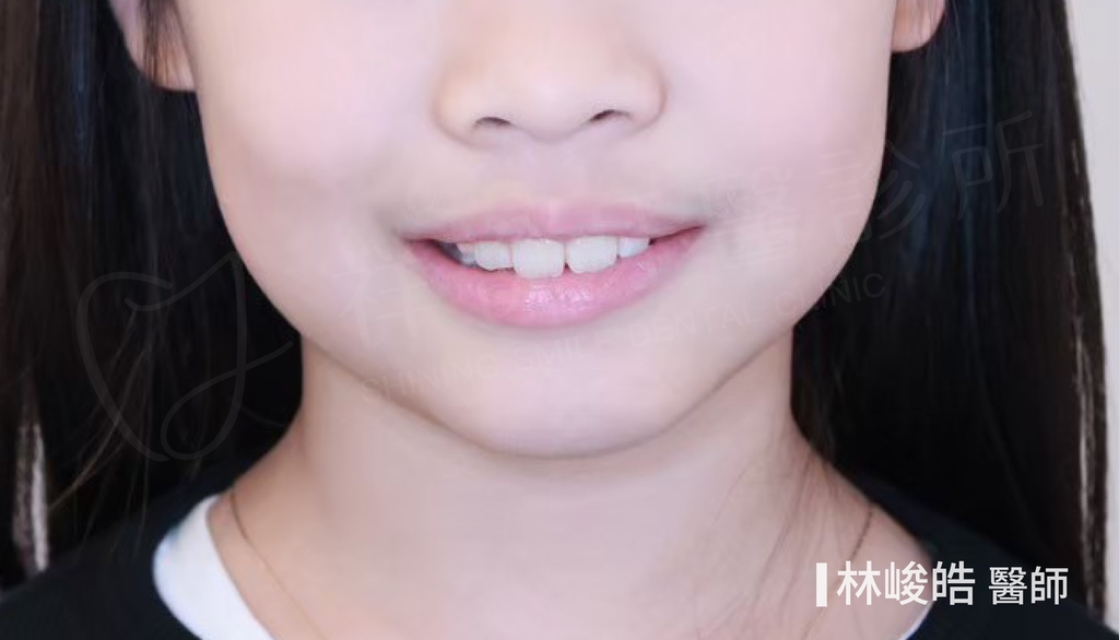 隱適美矯正治療前