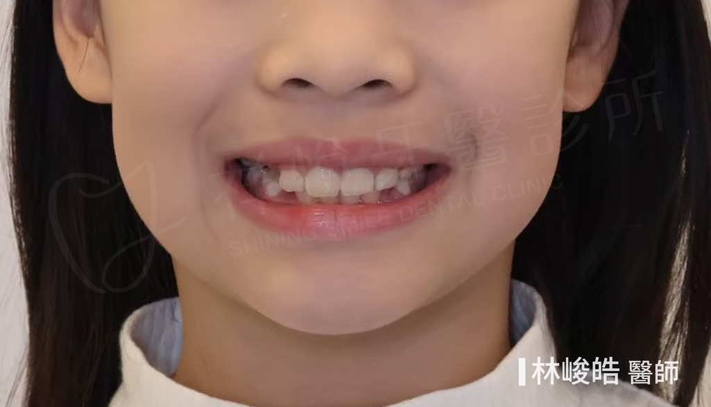 隱適美矯正治療後