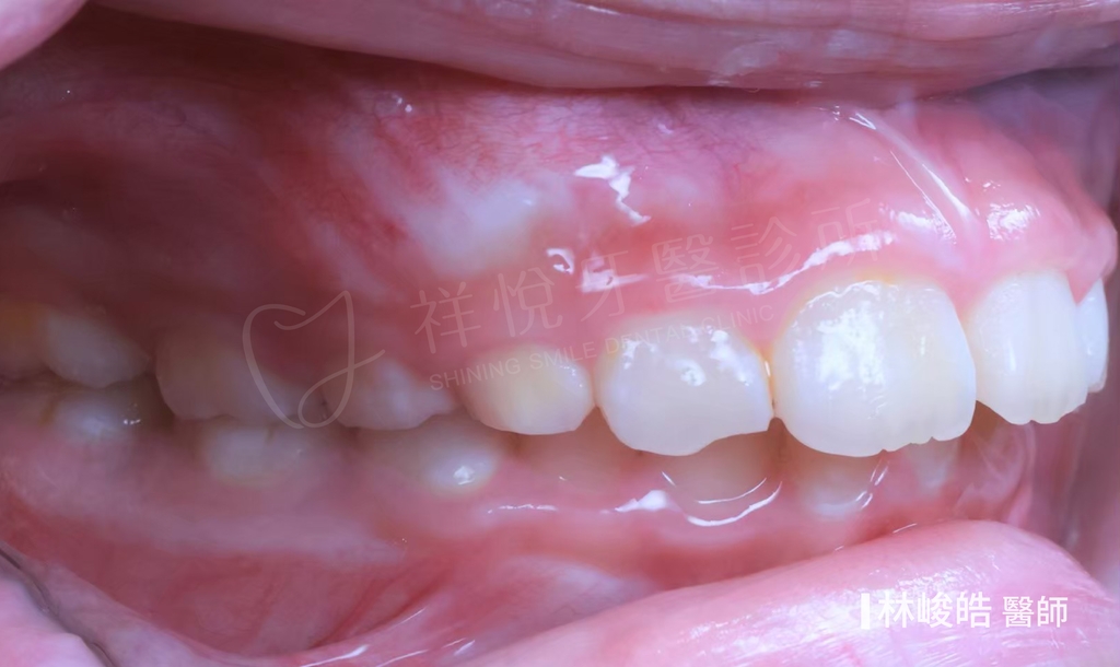 隱適美矯正治療前