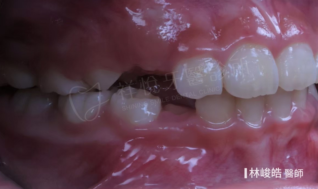 隱適美矯正治療後