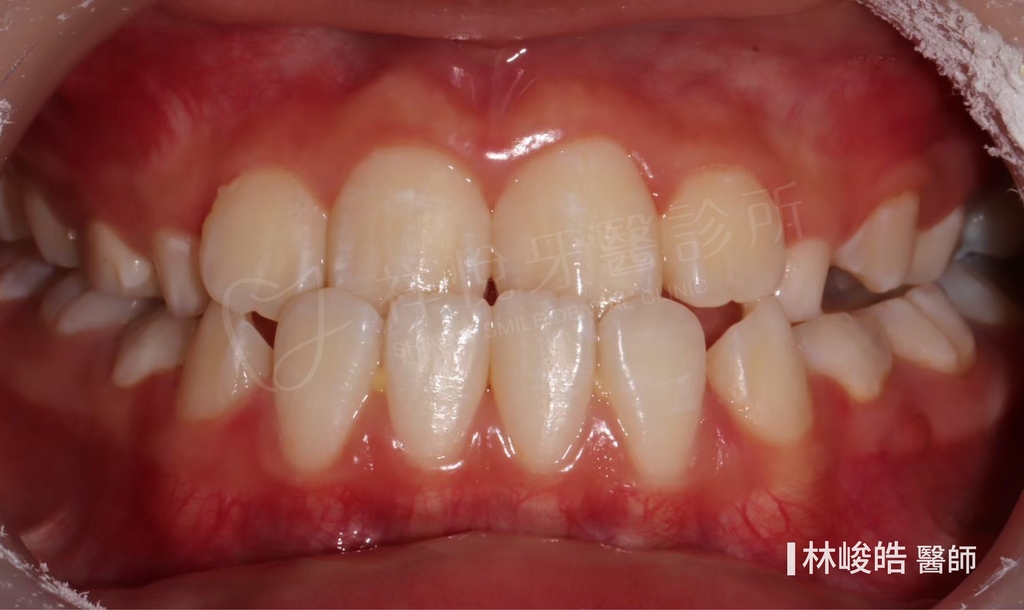 隱適美矯正治療前