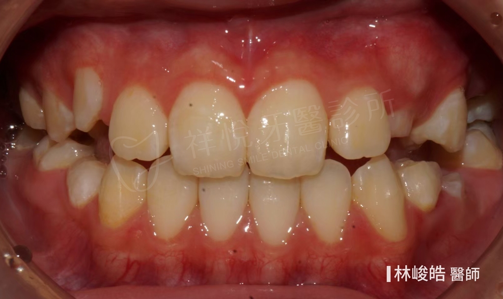 隱適美矯正治療後