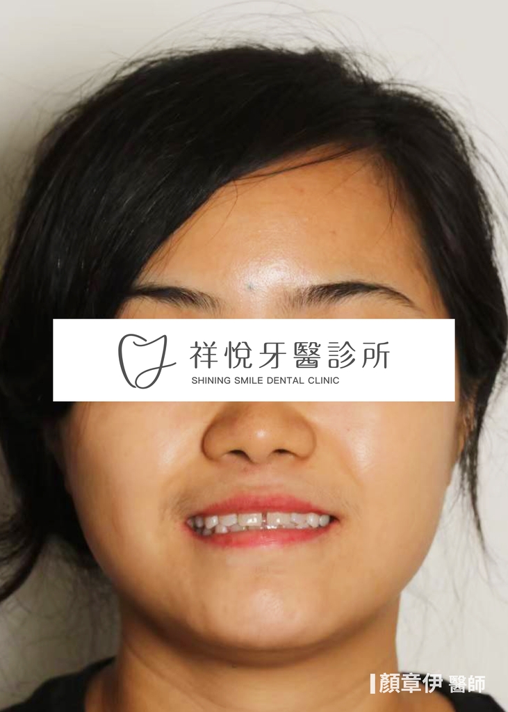 隱適美矯正治療前