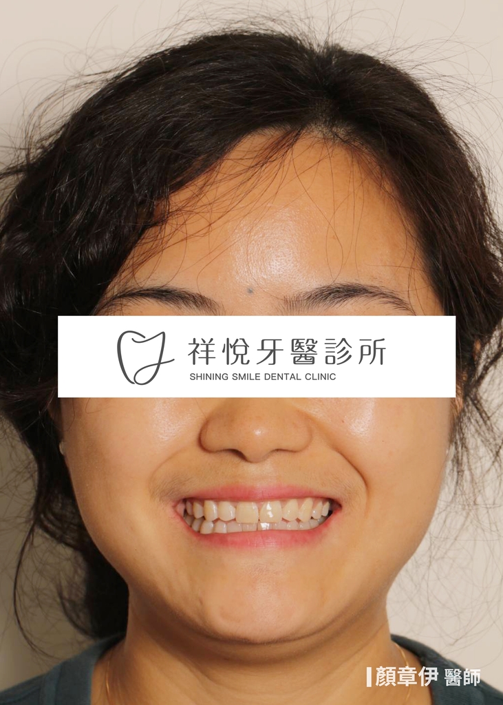 隱適美矯正治療後