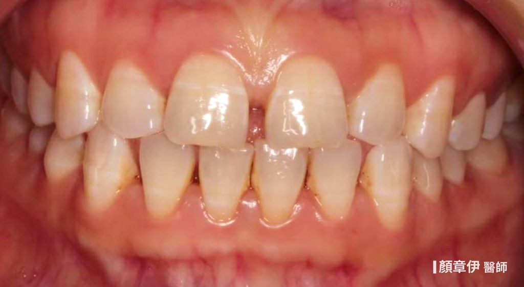 隱適美矯正治療前