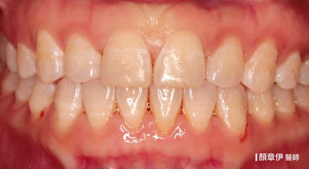 隱適美矯正治療後