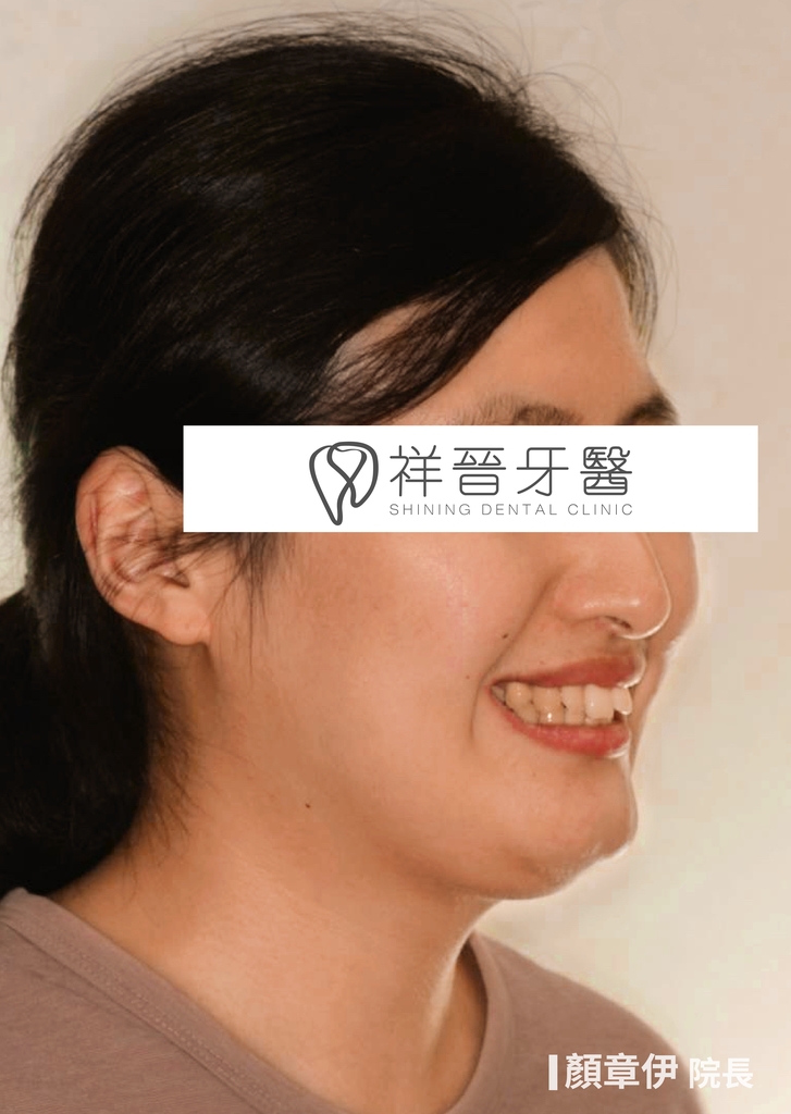 隱適美矯正治療前