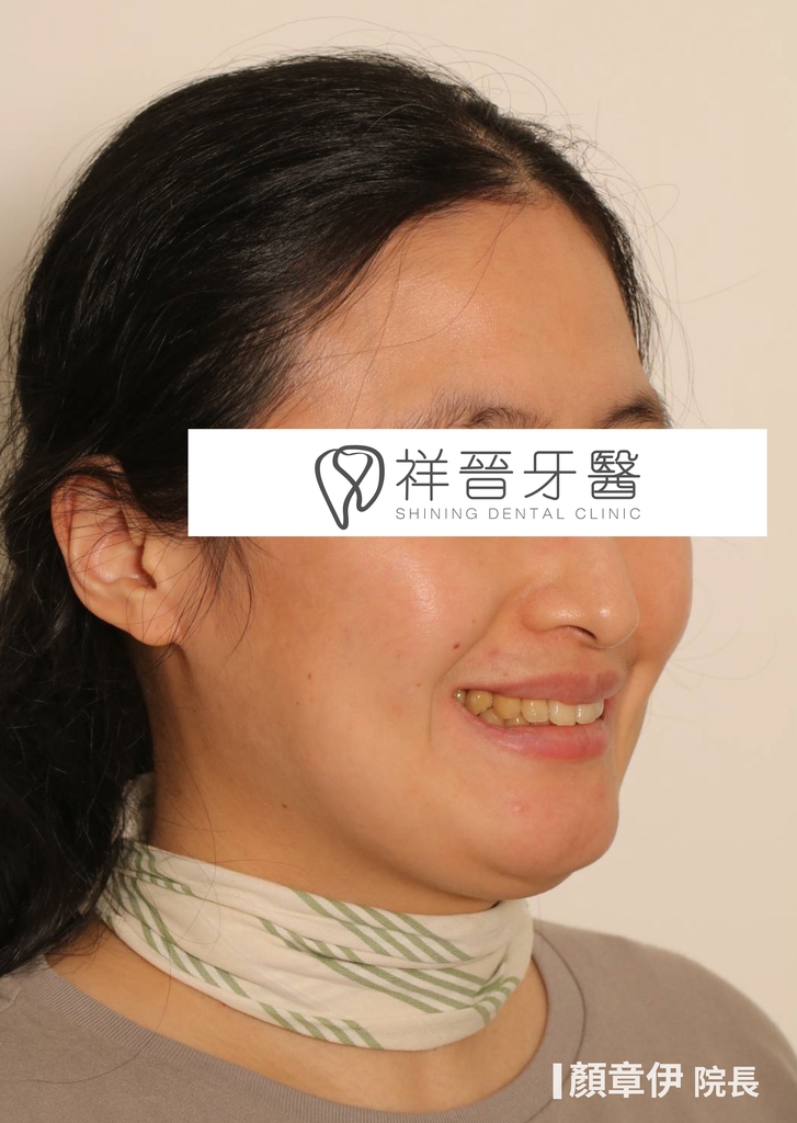 隱適美矯正治療後