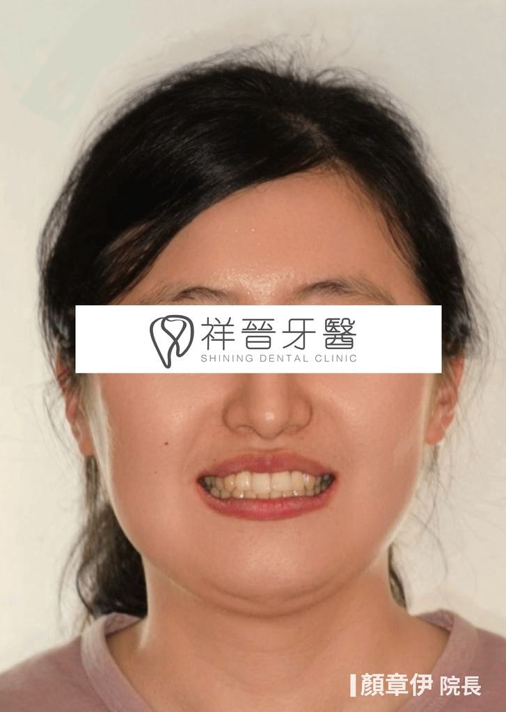 隱適美矯正治療前