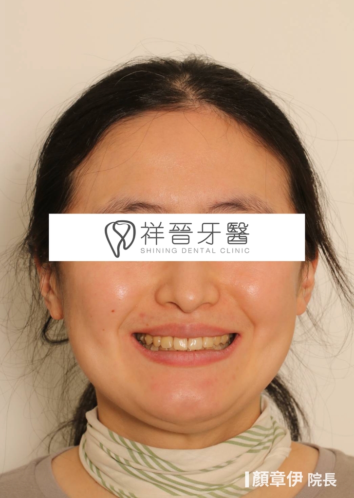 隱適美矯正治療後