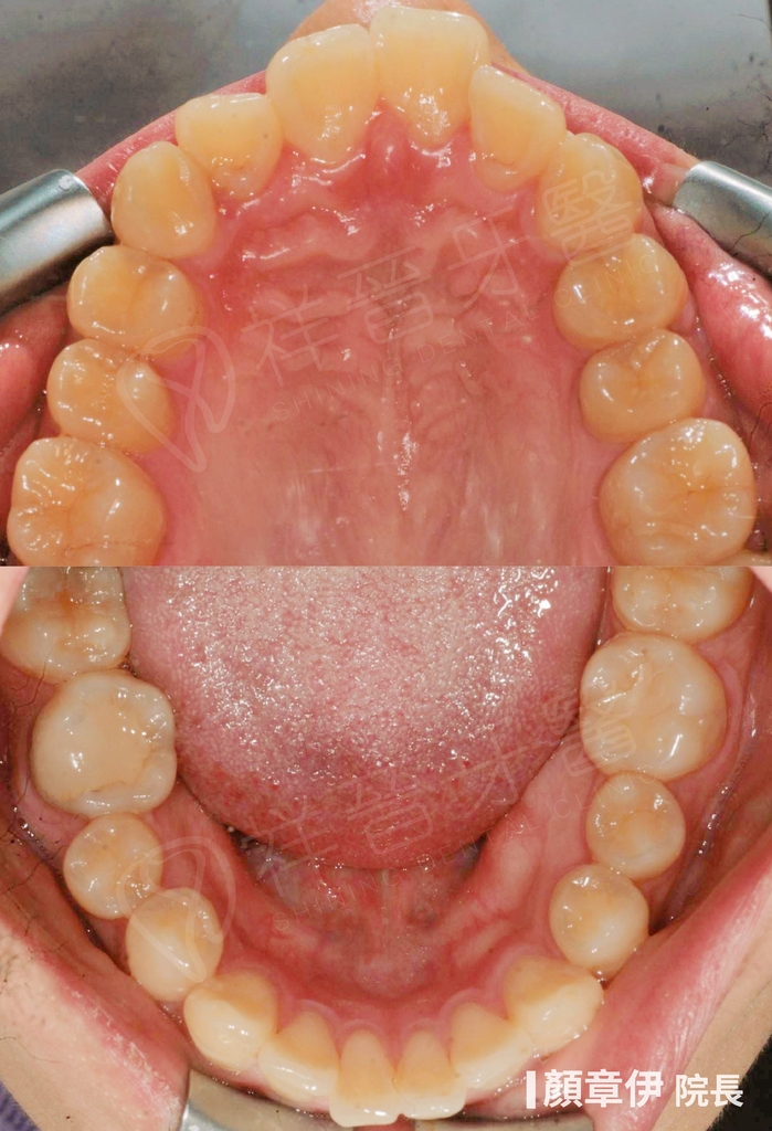 隱適美矯正治療前