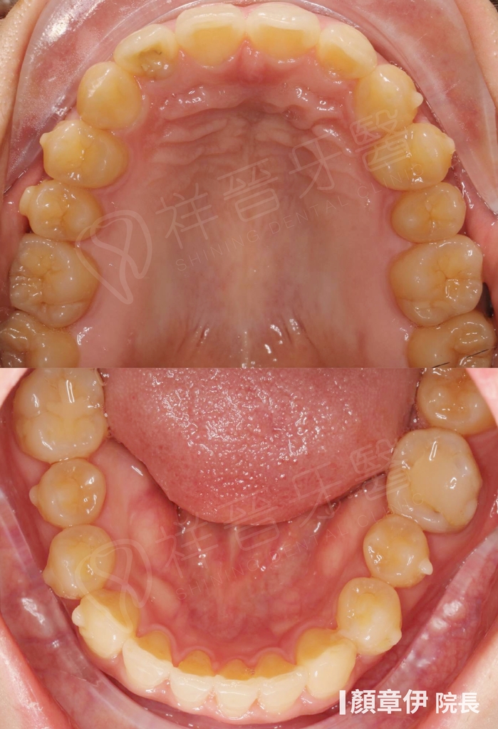 隱適美矯正治療後