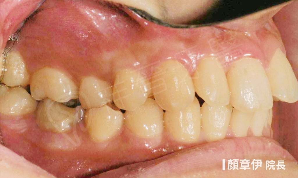 隱適美矯正治療前