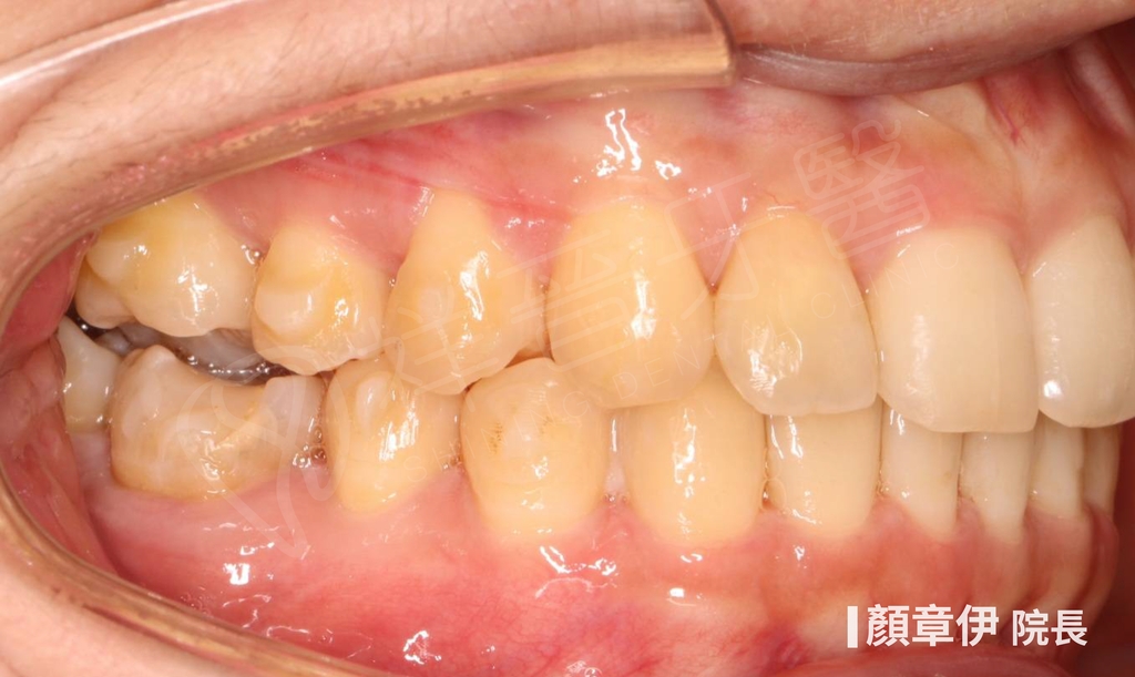 隱適美矯正治療後