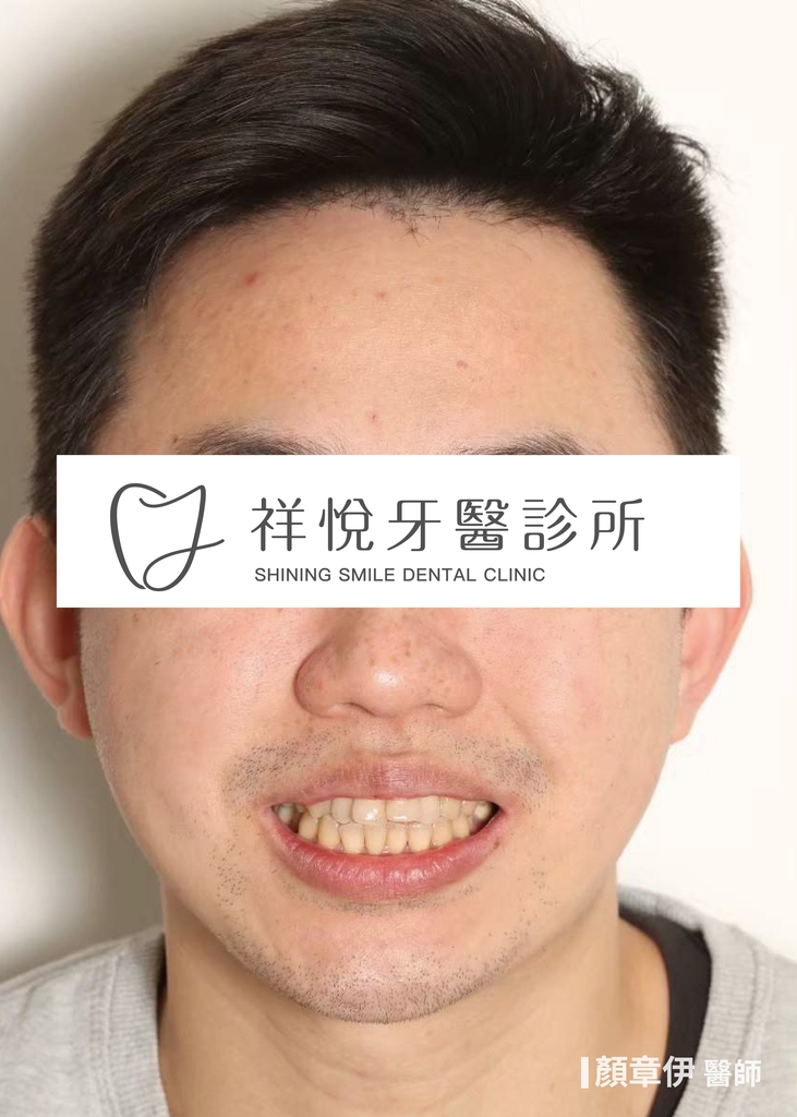 隱適美矯正治療前