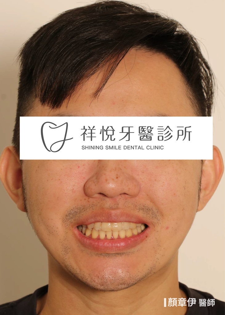 隱適美矯正治療後