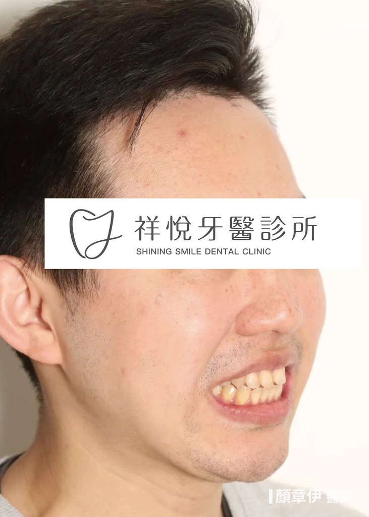 隱適美矯正治療前