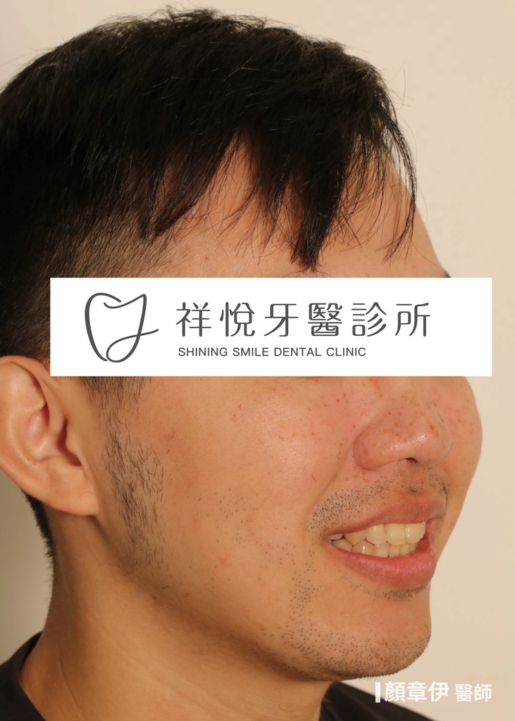 隱適美矯正治療後