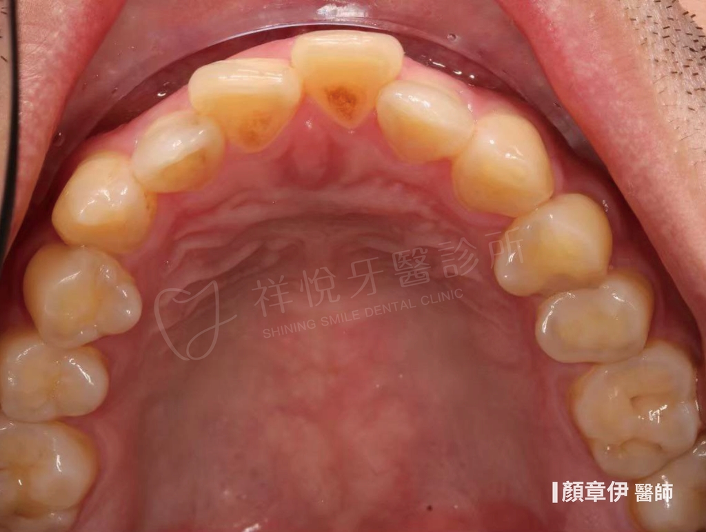 隱適美矯正治療前