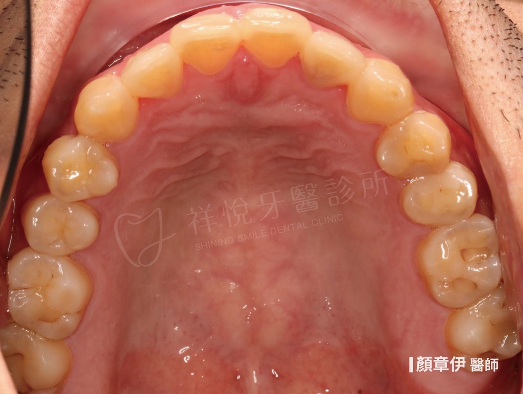 隱適美矯正治療後