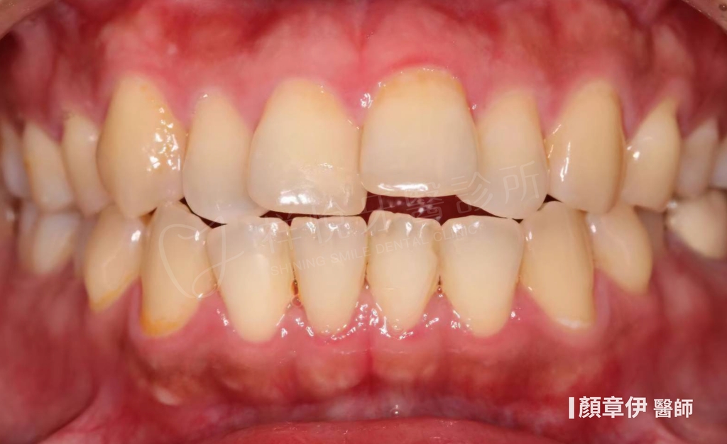 隱適美矯正治療前