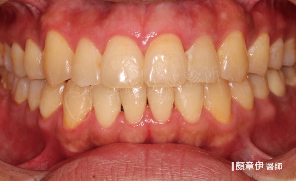 隱適美矯正治療後