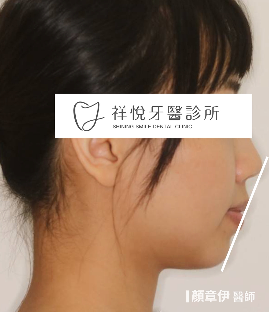 隱適美矯正治療前