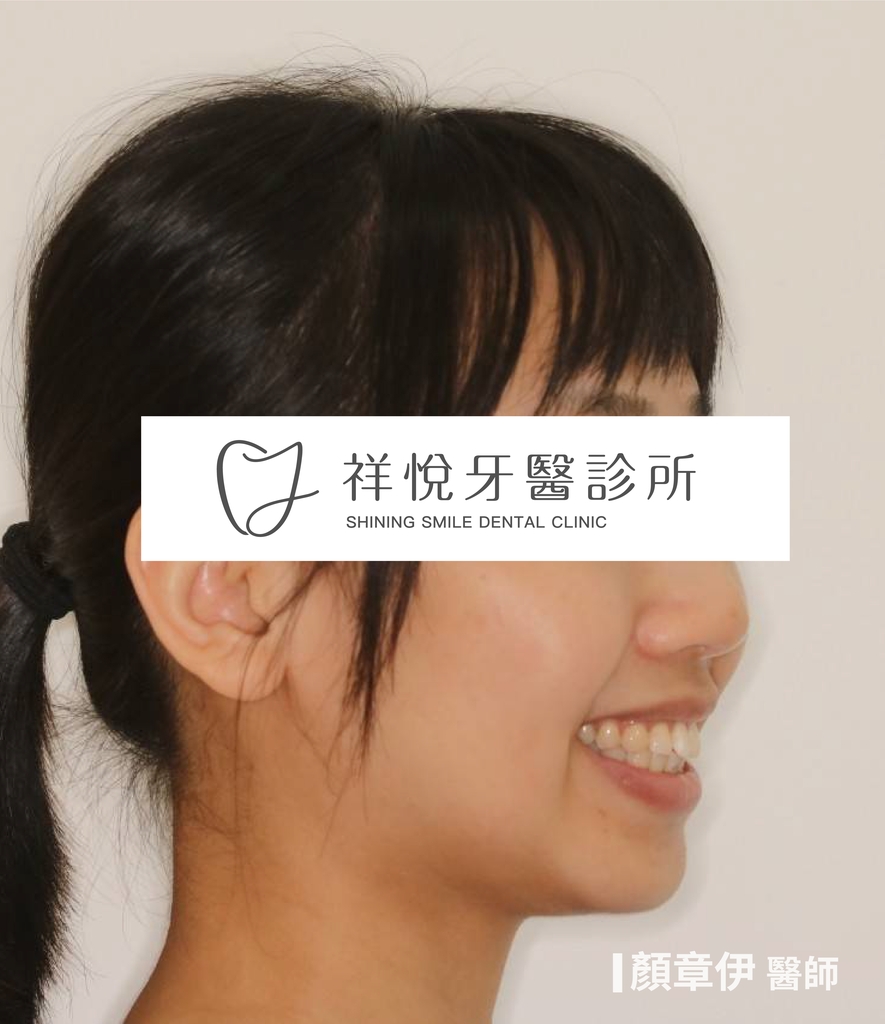 隱適美矯正治療前