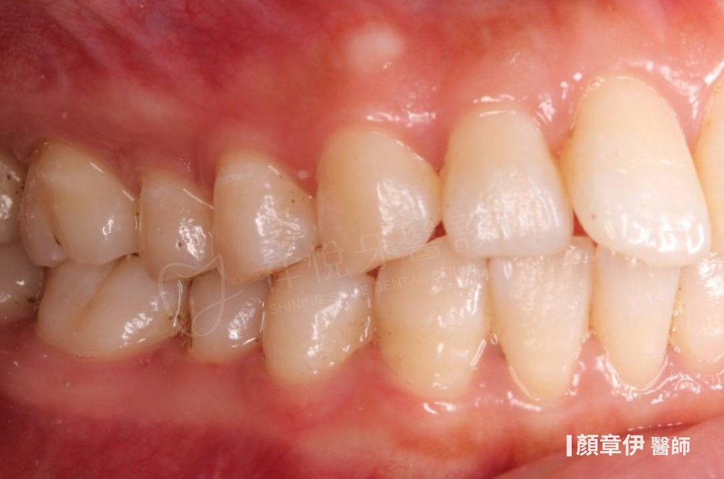 隱適美矯正治療前