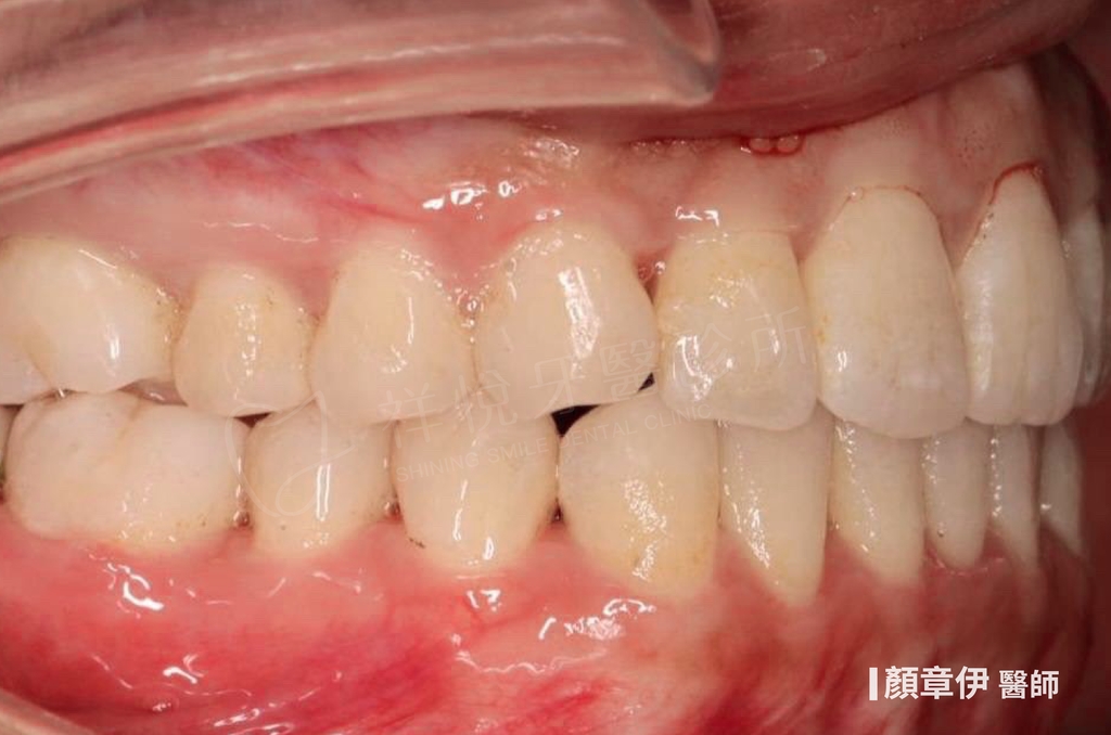 隱適美矯正治療後