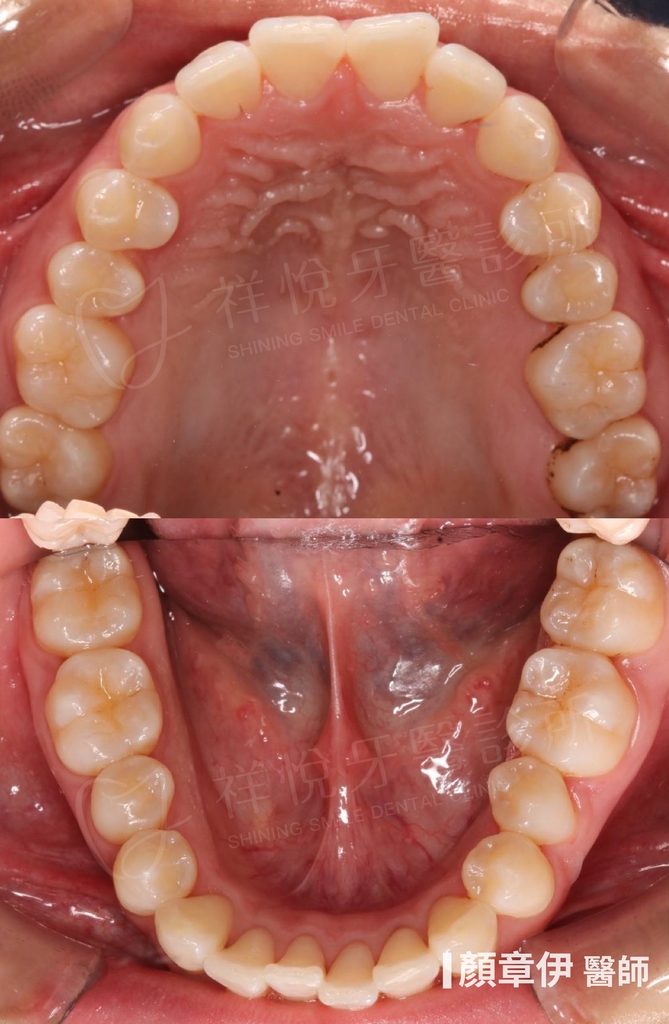 隱適美矯正治療前