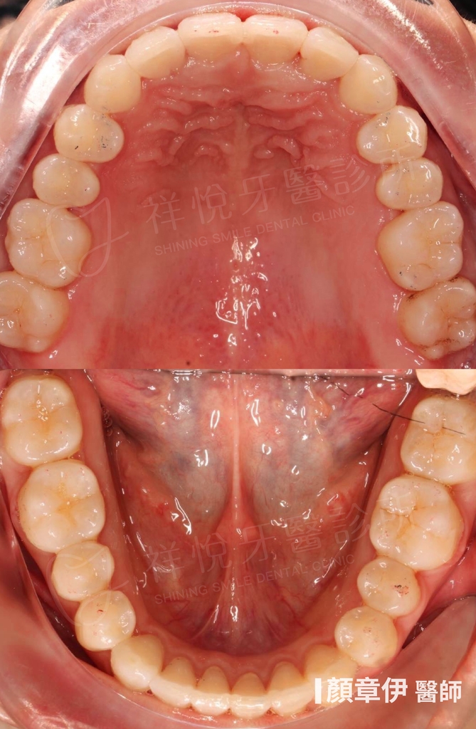 隱適美矯正治療後