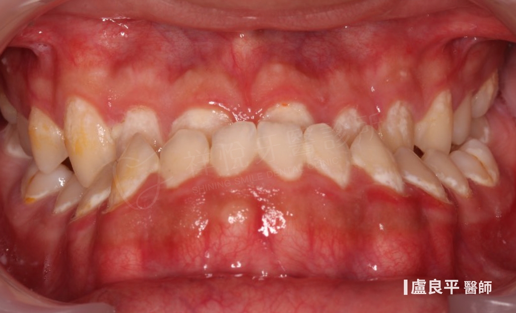 傳統矯正治療前