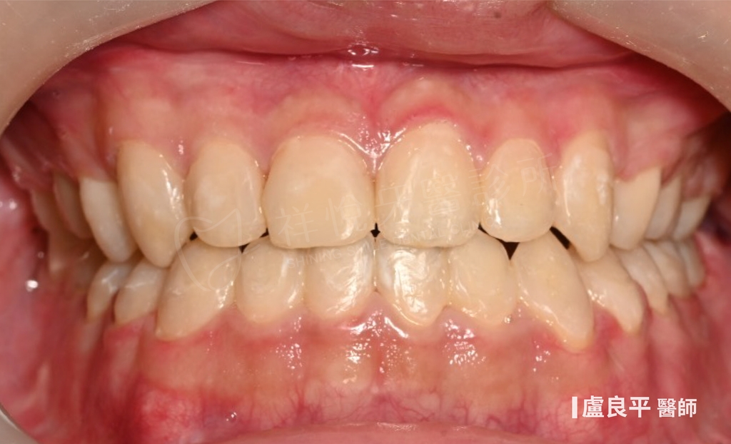 傳統矯正治療後