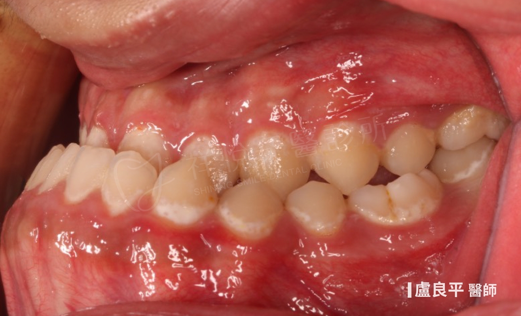 傳統矯正治療前