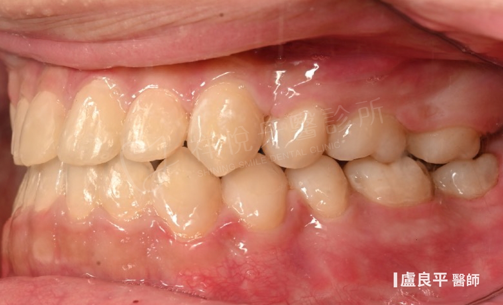 傳統矯正治療後