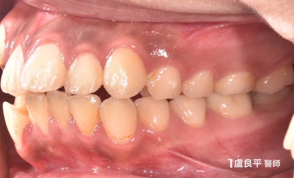 傳統矯正治療前