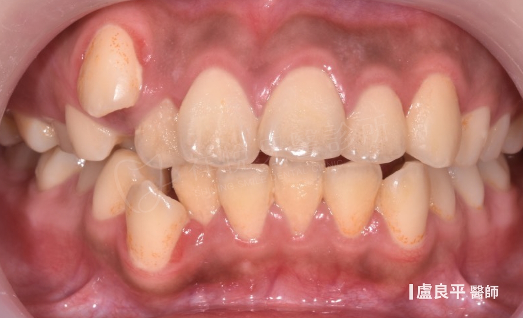 傳統矯正治療前