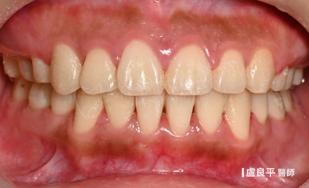 傳統矯正治療後