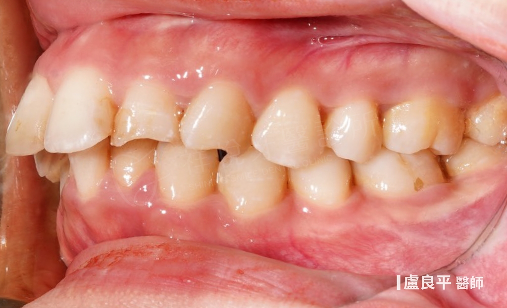 傳統矯正治療前