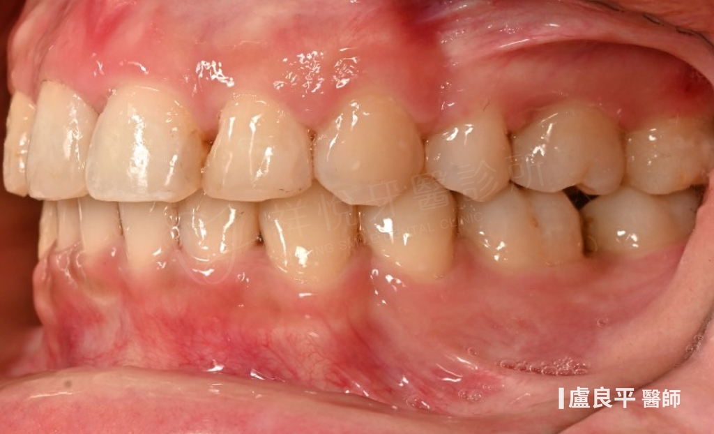 傳統矯正治療後