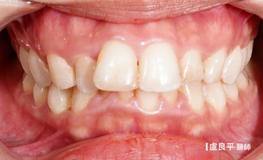 傳統矯正治療前