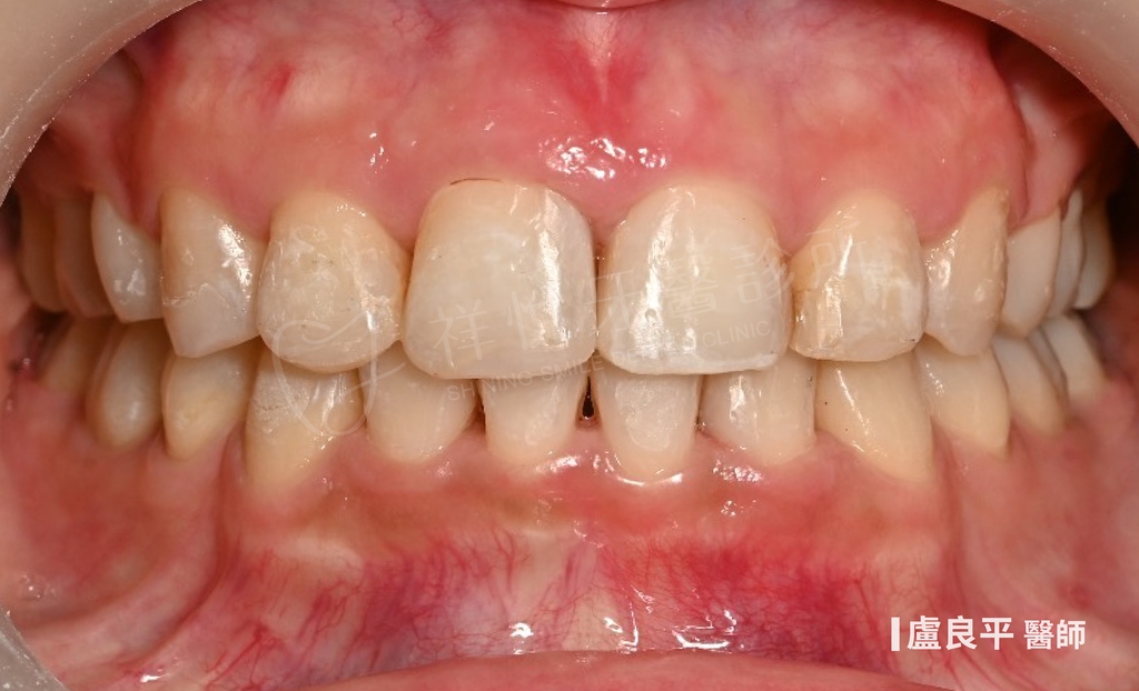 傳統矯正治療後