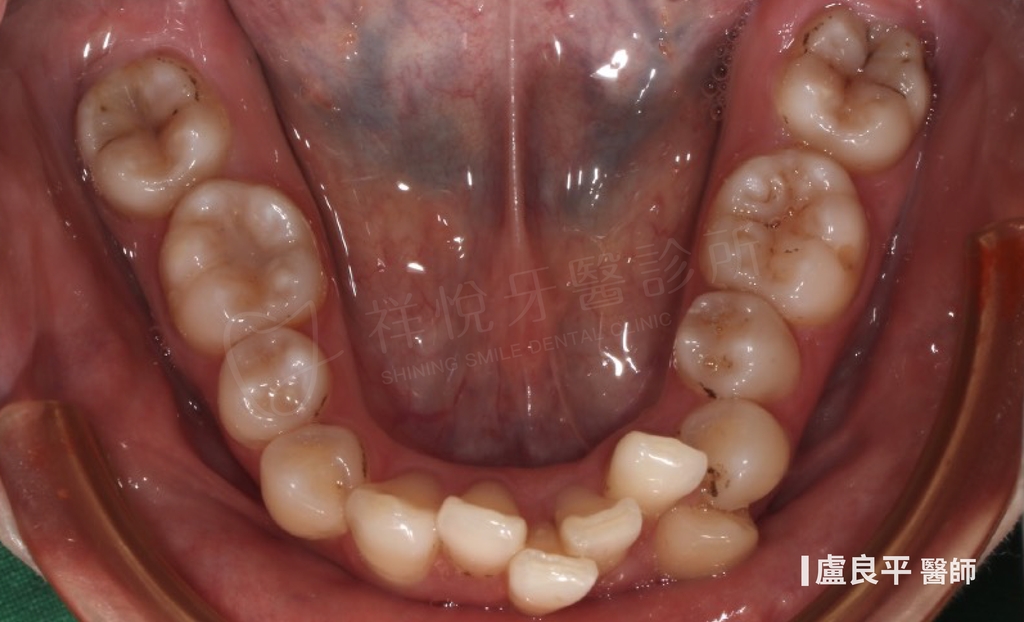 傳統矯正治療前