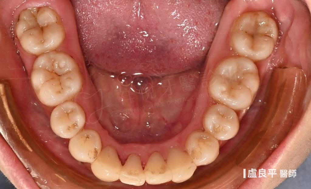 傳統矯正治療後