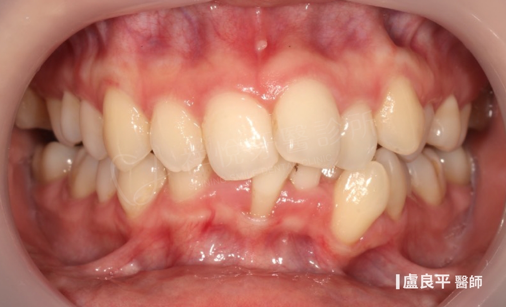 傳統矯正治療前