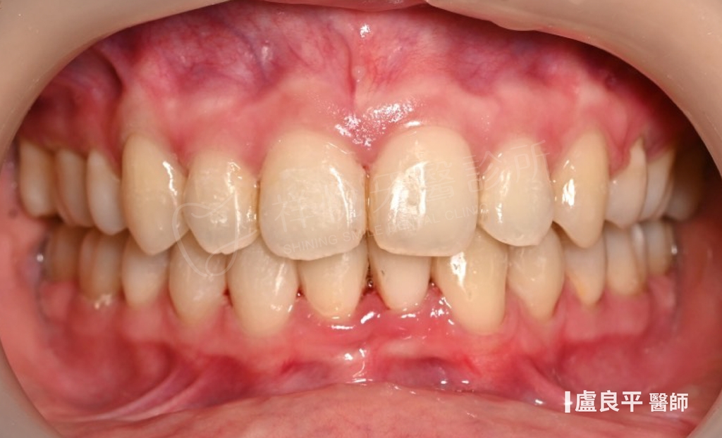 傳統矯正治療後