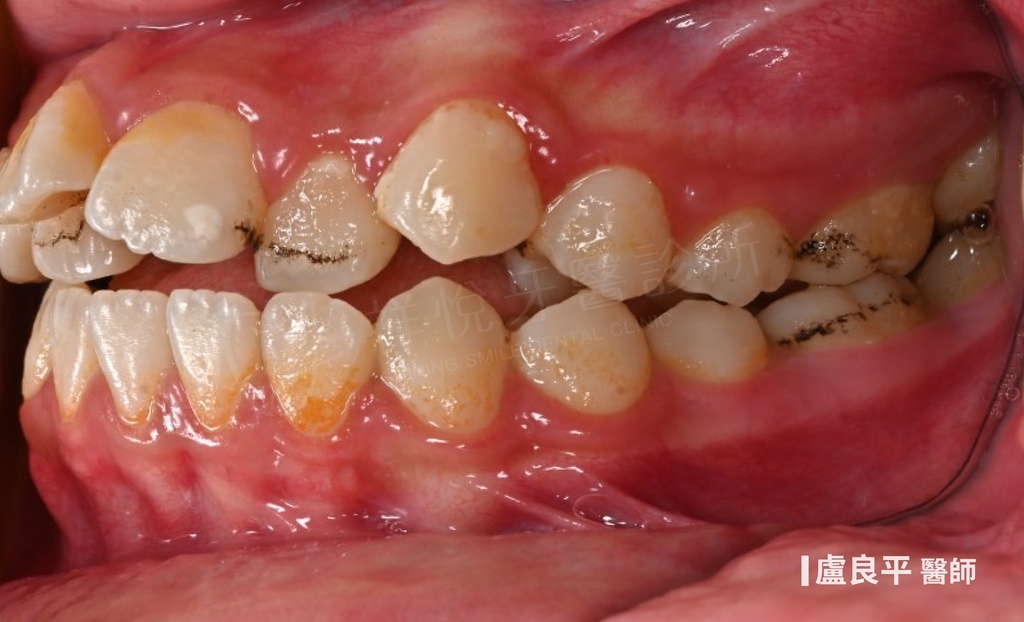 傳統矯正治療前