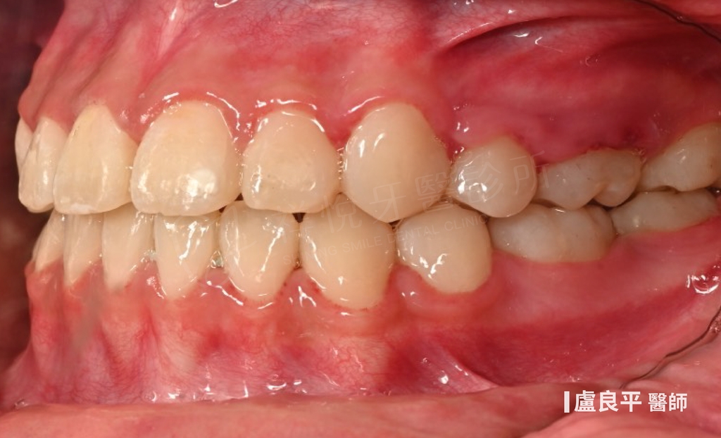傳統矯正治療後