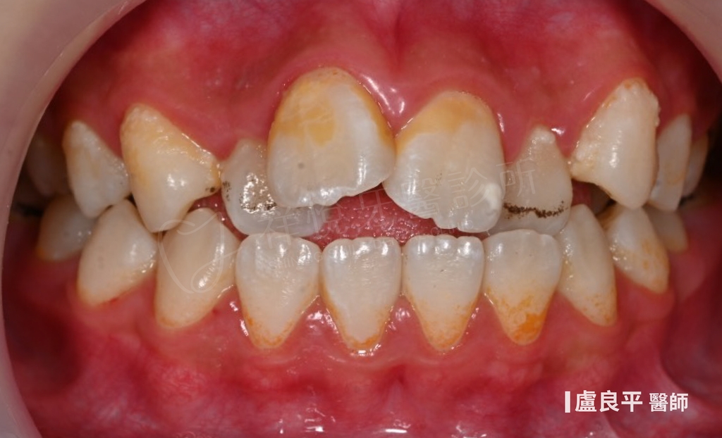 傳統矯正治療前